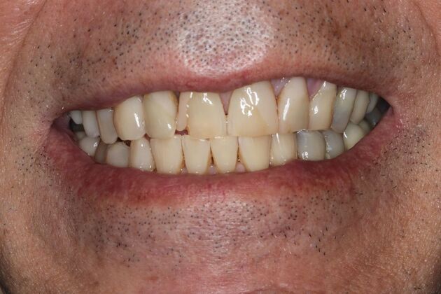 Veneers: Case 31 - Before