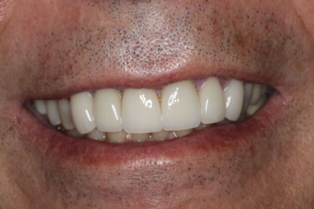 Veneers: Case 31 - After