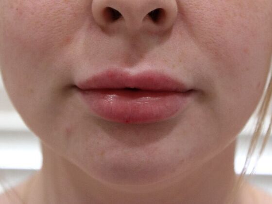Injectables Case 36 - After