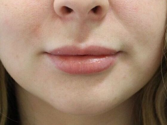 Injectables Case 36 - Before