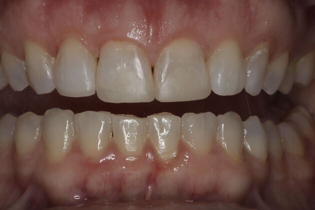 Invisalign Case 5 - After