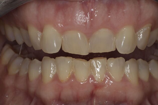 Invisalign Case 5 - Before
