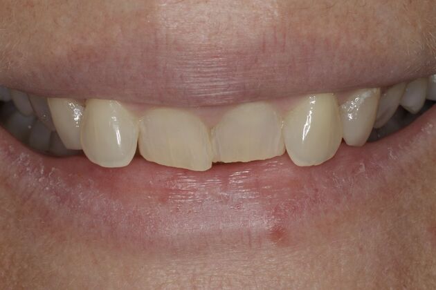 Invisalign: Case 5 - Before