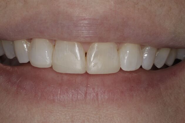 Invisalign: Case 5 - After