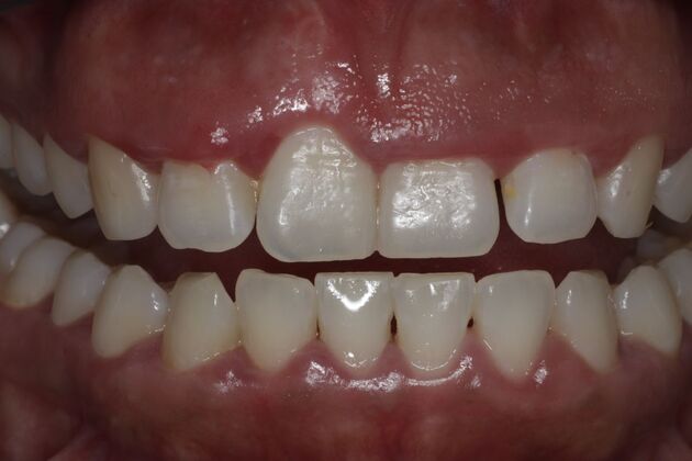 Laser Gum Reshaping Case 8 - Before