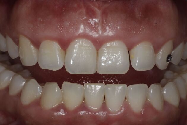 Laser Gum Reshaping Case 8 - After