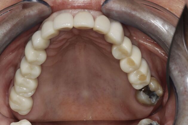 Dental Implants: Case 6 - After