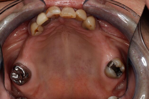 Dental Implants: Case 6 - Before