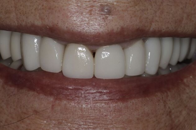 Dental Implants Case 6 - After