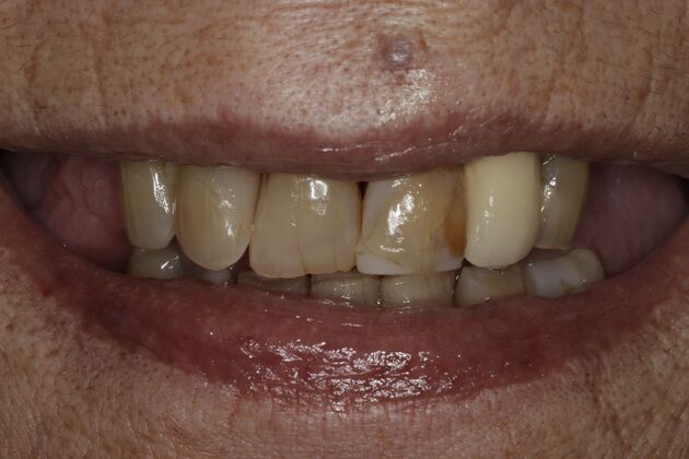 Dental Implants Case 6 - Before
