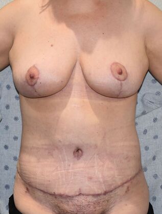 Mommy Makeover Case 260 - After