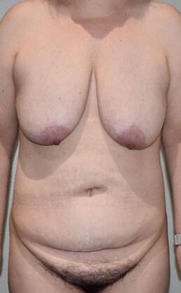 Massive Weight Loss : Case 123 - Before