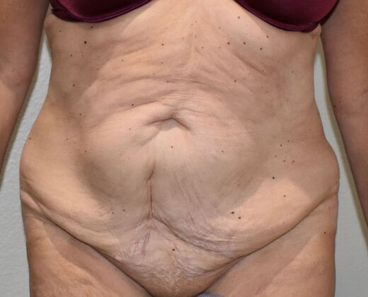 Massive Weight Loss : Case 124 - Before