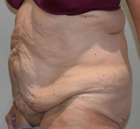 Massive Weight Loss : Case 124 - Before