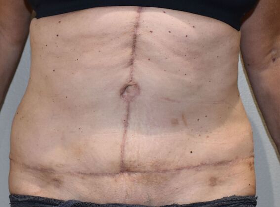 Massive Weight Loss : Case 124 - After