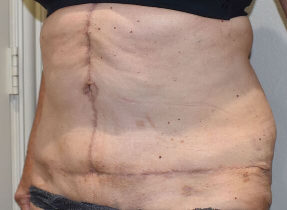 Massive Weight Loss : Case 124 - After