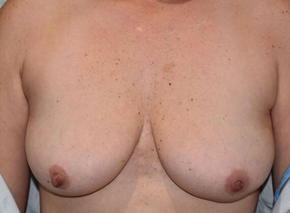 Breast Augmentation w/ Lift Case 477 - Before