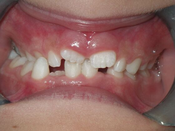 Orthodontic treatment in Phases: Case 8 - Before