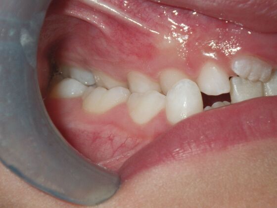 Orthodontic treatment in Phases: Case 8 - Before