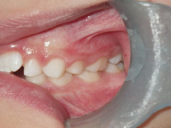 Orthodontic treatment in Phases: Case 8 - Before