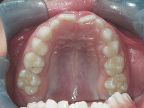 Orthodontic treatment in Phases: Case 8 - Before