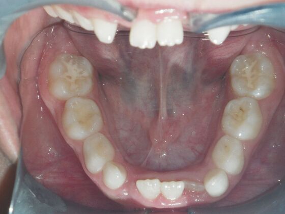 Orthodontic treatment in Phases: Case 8 - Before