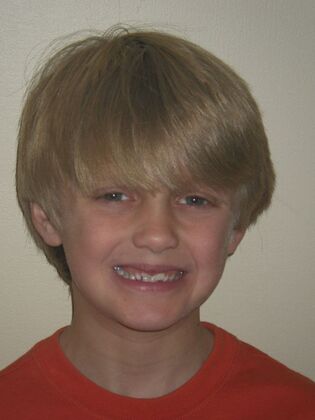 Orthodontic treatment in Phases: Case 8 - Before