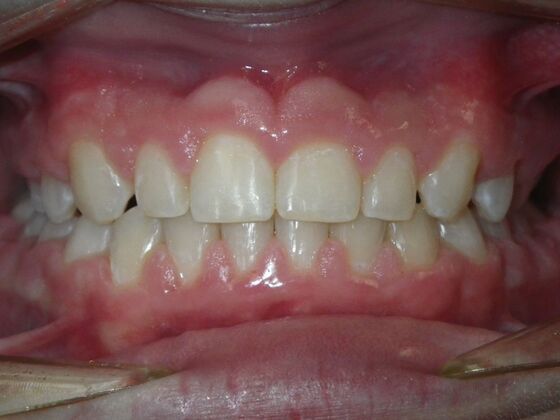 Orthodontic treatment in Phases: Case 8 - After