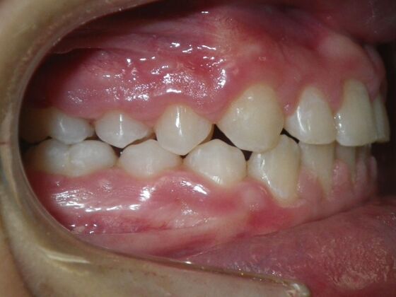 Orthodontic treatment in Phases: Case 8 - After