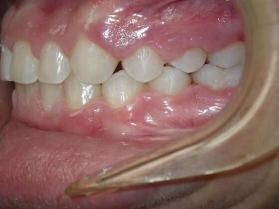 Orthodontic treatment in Phases: Case 8 - After