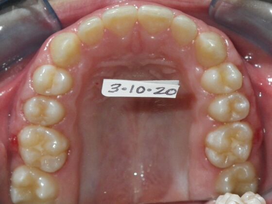 Orthodontic treatment in Phases: Case 8 - After