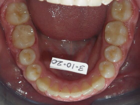 Orthodontic treatment in Phases: Case 8 - After