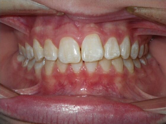 Orthodontics: Case 35 - Before