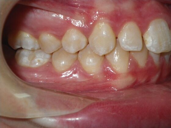 Orthodontics: Case 35 - Before