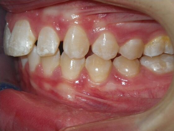 Orthodontics: Case 35 - Before