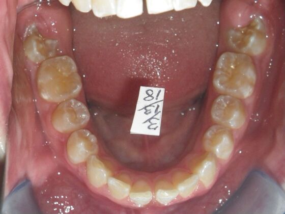 Orthodontics: Case 35 - Before