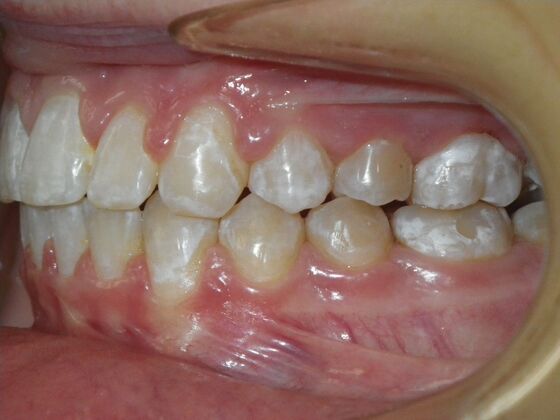 Orthodontics: Case 35 - After
