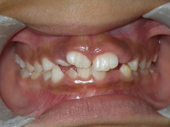 Orthodontic treatment in Phases: Case 9 - Before