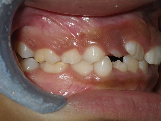 Orthodontic treatment in Phases: Case 9 - After