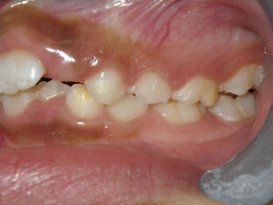Orthodontic treatment in Phases: Case 9 - Before