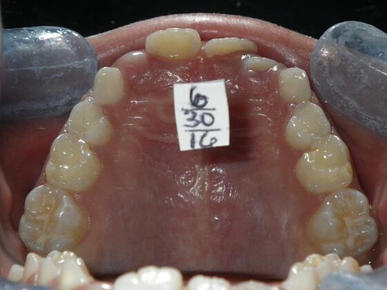 Orthodontic treatment in Phases: Case 9 - After