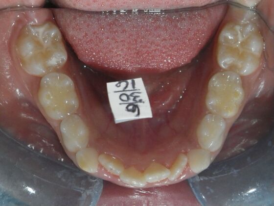 Orthodontic treatment in Phases: Case 9 - Before