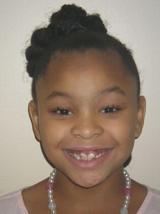 Orthodontic treatment in Phases Case 9 - Before