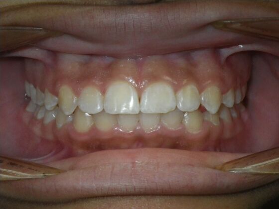 Orthodontic treatment in Phases: Case 9 - After