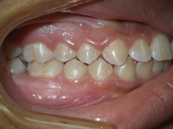 Orthodontic treatment in Phases: Case 9 - Before