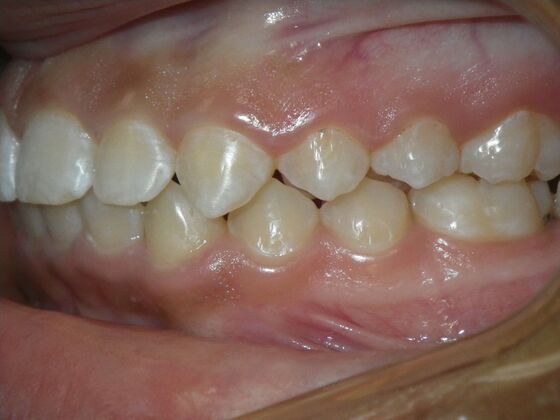 Orthodontic treatment in Phases: Case 9 - After