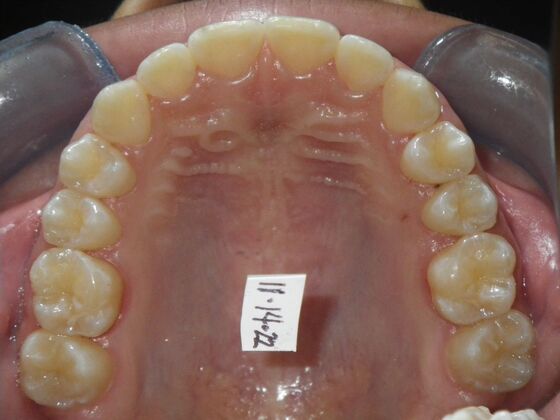 Orthodontic treatment in Phases: Case 9 - Before