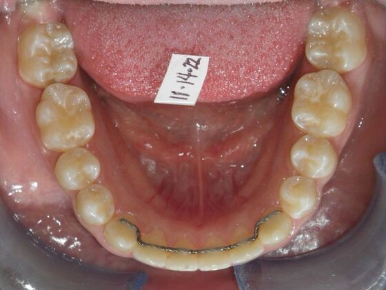 Orthodontic treatment in Phases: Case 9 - After