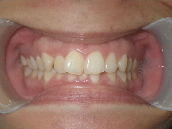 Orthodontics: Case 38 - Before