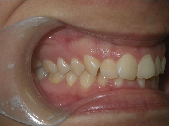 Orthodontics: Case 38 - Before